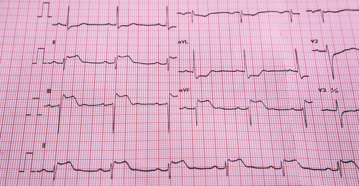 ΗΚΓ - STEMI - σημεία ανύψωσης του ST και έμφραγμα του καρδιακού μυός