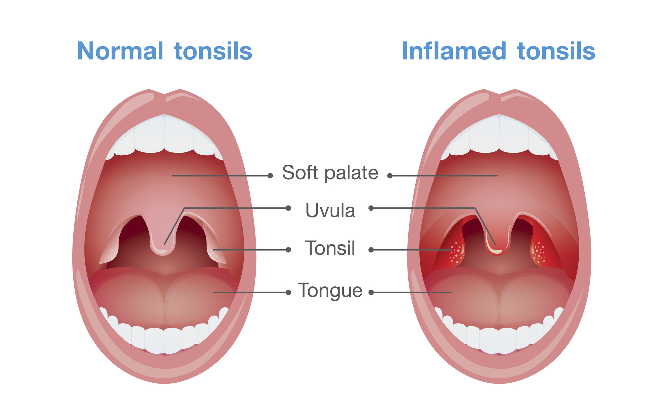 Angina - φλεγμονή των αμυγδαλών