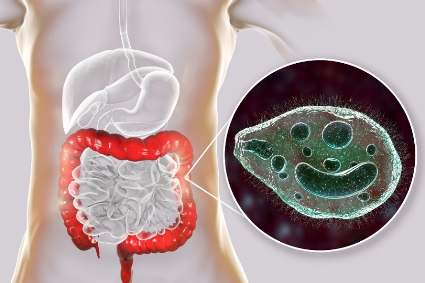 Balantidium coli - παράσιτο που μολύνει το παχύ έντερο του ανθρώπινου πεπτικού συστήματος