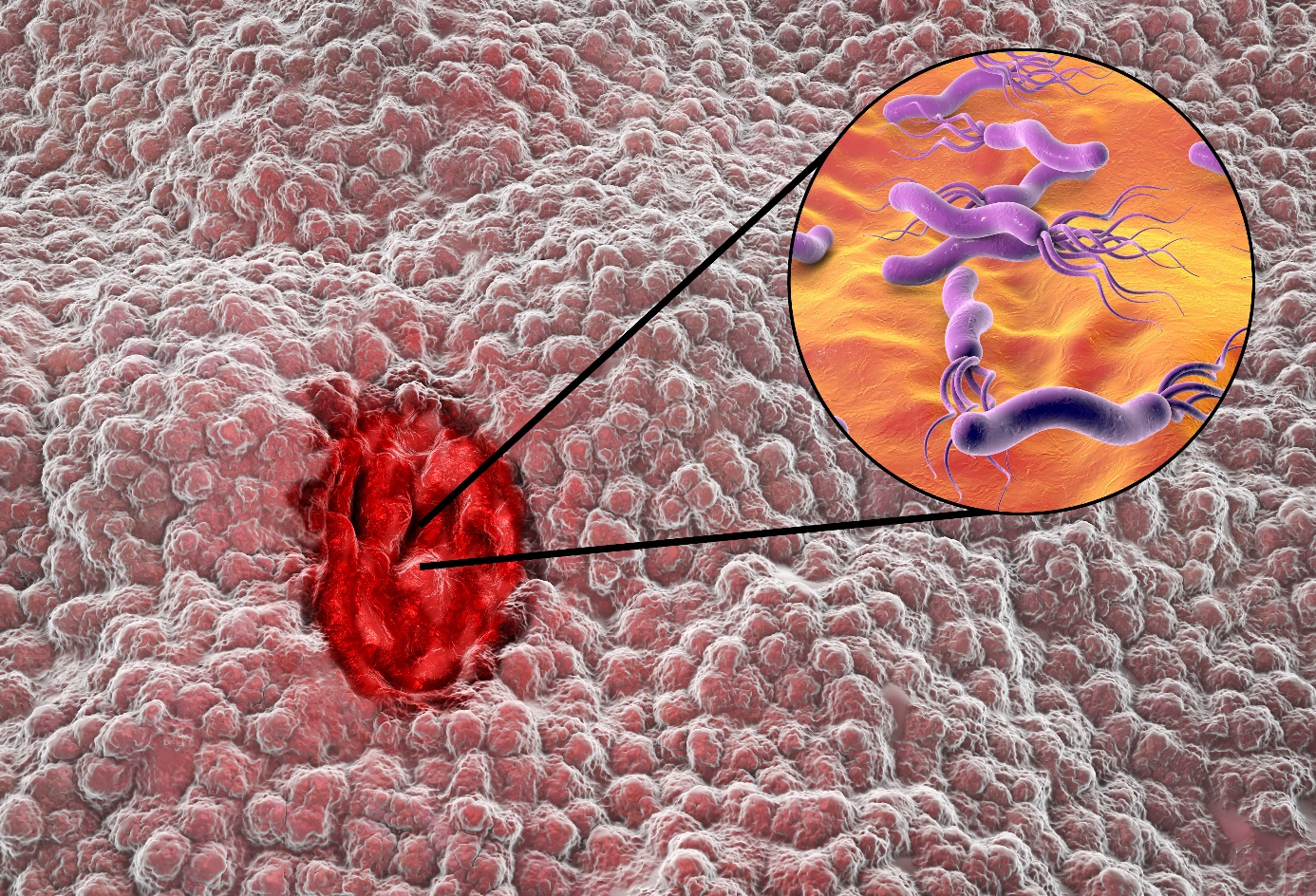 Λοίμωξη από Helicobacter pylori