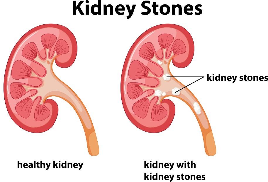 Πέτρες στα νεφρά