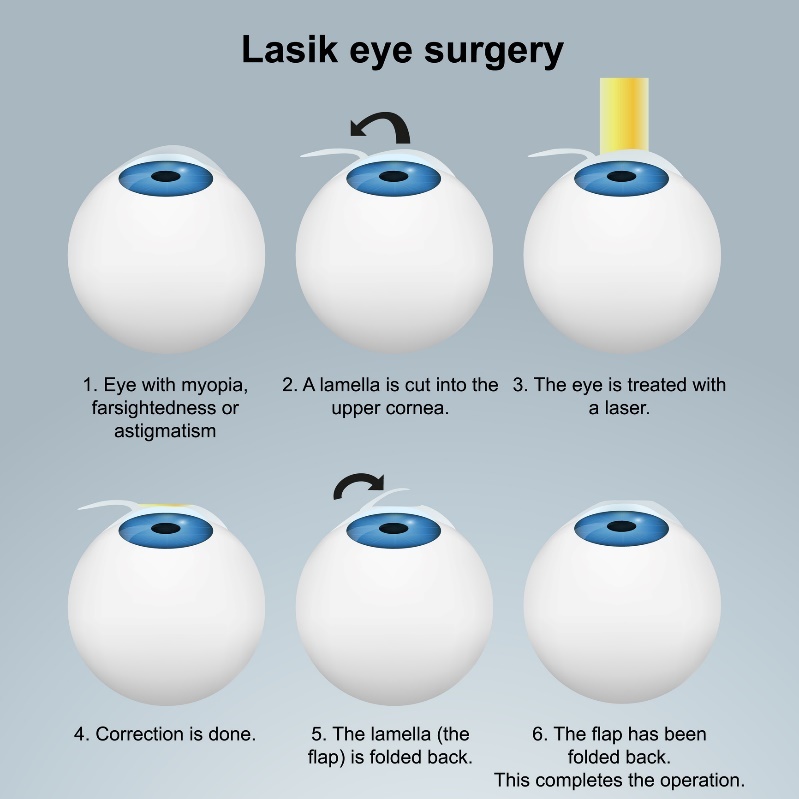 Οφθαλμοχειρουργική με λέιζερ LASIK - υποεπιφανειακή μέθοδος. Διαδικασία με κρημνό/πτερύγιο χωρίς να καταστρέφονται οι νευρικές απολήξεις.