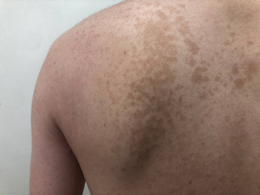 Pityriasis versicolor: Τι είναι και τι συμπτώματα έχει; Αιτίες και μετάδοση